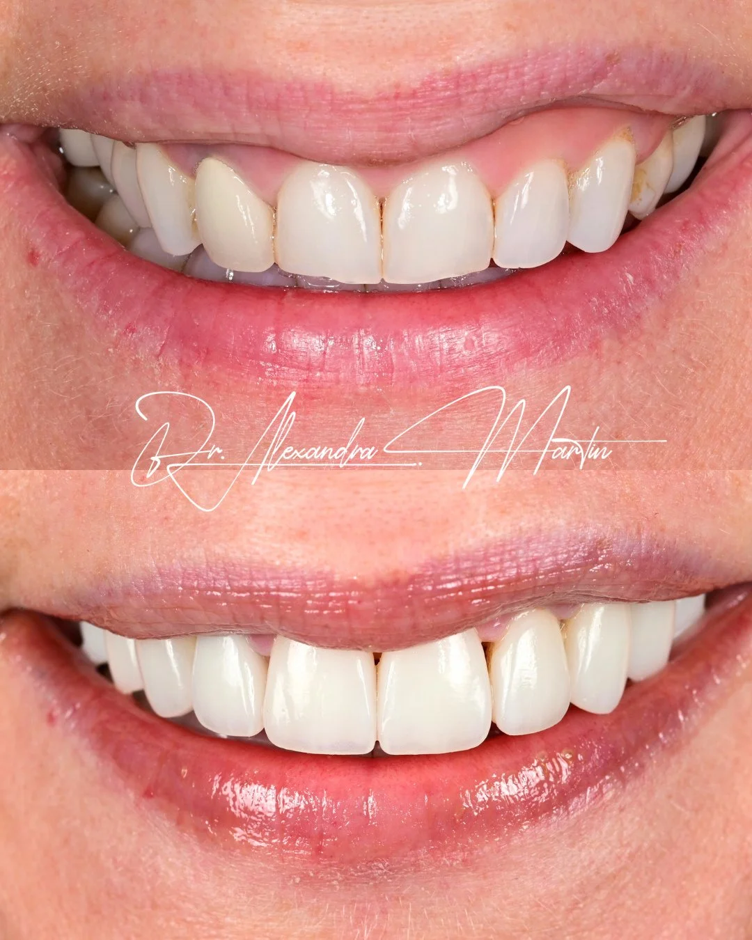 This smile transformation focused on restoring structure as much as aesthetics. By completing 12 veneers on top, 14 on the bottom, and replacing existing crowns where needed, we were able to rebuild bite support, improve proportions, and create a mor