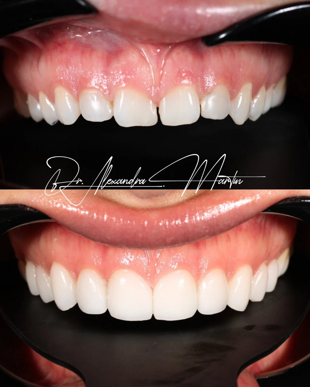 This case was about refreshing old dental work while creating a smile that felt clean, cohesive, and natural ✨⁠
⁠
By replacing stained bonding with 10 minimal prep veneers, we were able to close anterior spacing and improve overall balance while pres