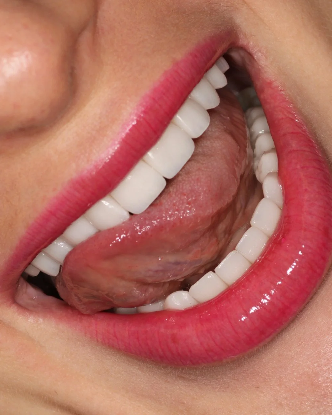 An almost outrageous take on veneers&hellip; 🦷⁠
⁠
Here is something that feels counterintuitive. The best veneer cases often involve doing less, not more. Preserving enamel, respecting natural edges, and avoiding unnecessary bulk creates results tha