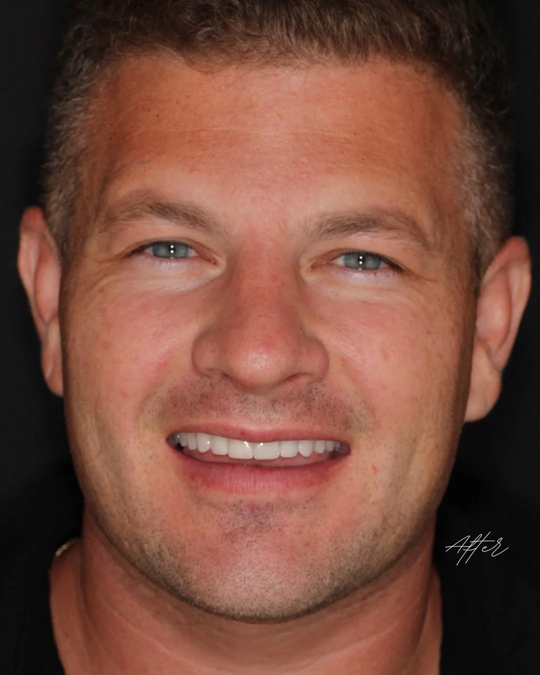 The part most people never see is the evaluation.

Before anything is designed, I am studying how your teeth function together, how your lips move when you speak, and how forces distribute across each surface over time. These details determine whethe