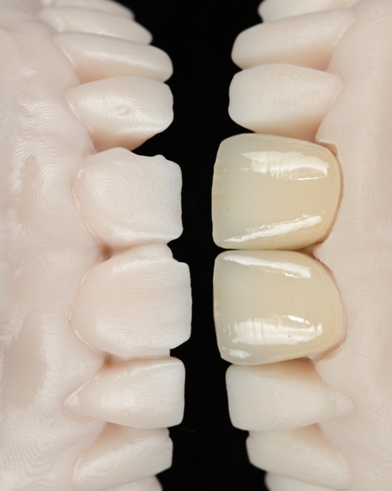 This case involved two veneers.

Worn edges were rebuilt and failing fillings were replaced. The greater challenge was not making the teeth brighter, but matching the translucency, surface texture, and light behavior of the surrounding enamel so the 