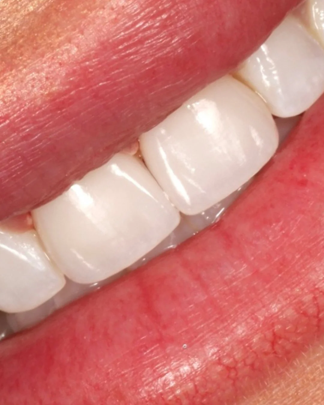 Up close, design becomes visible.⁠
⁠
You can see it in the translucency at the incisal edge and the way brightness is controlled rather than maximized. You can see it in the surface texture that keeps light from reflecting flat.⁠
⁠
None of that is ac