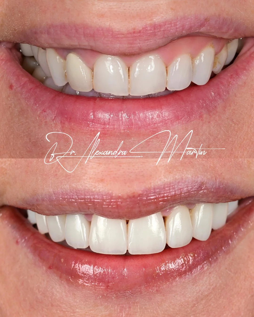 This case required rebuilding structure across both arches.⁠
⁠
Twelve upper and fourteen lower veneers were completed, with existing crowns replaced where they no longer supported the overall design. Vertical dimension was restored carefully, because