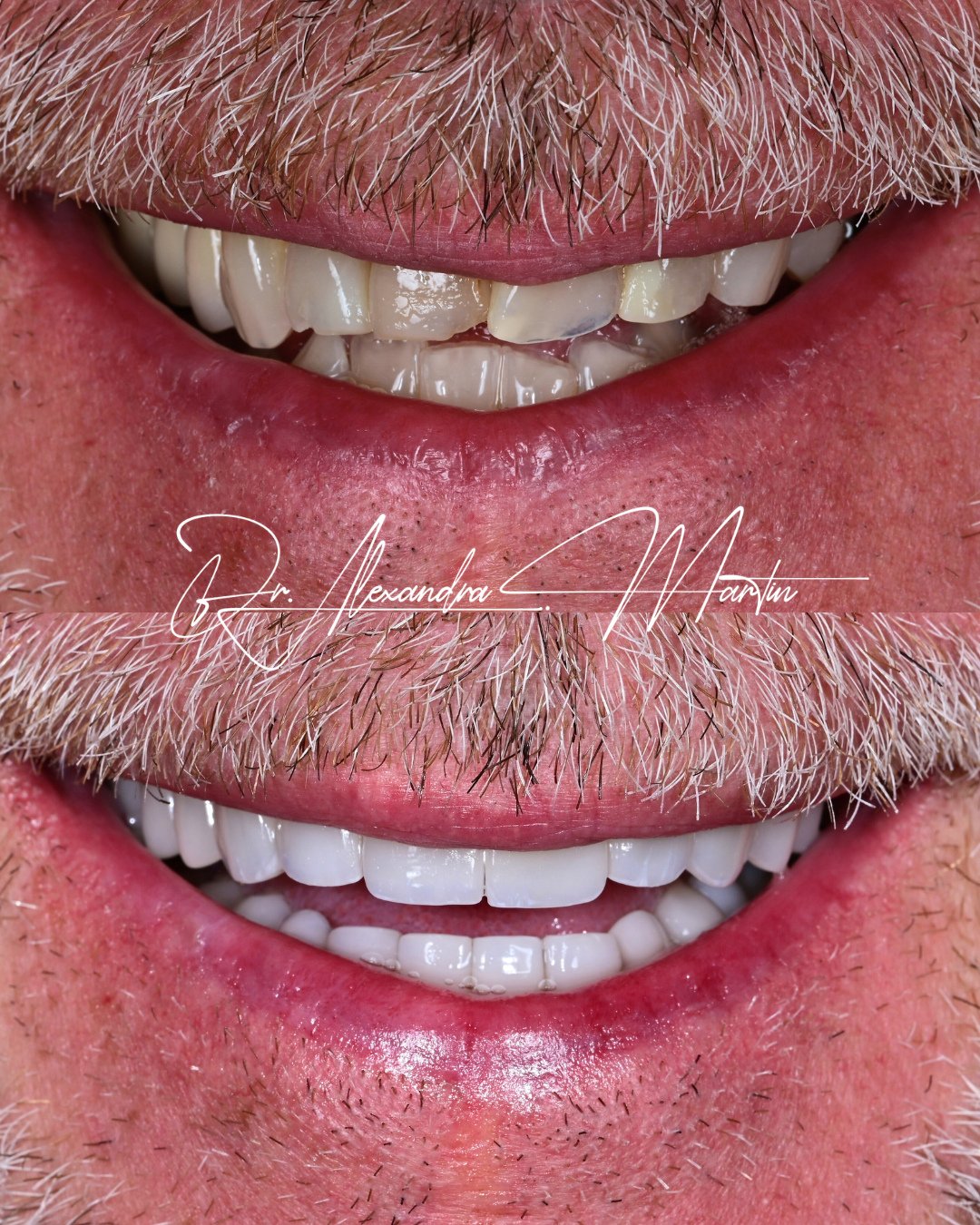 Ten veneers and crowns were placed on the upper arch and twelve on the lower to replace existing restorations that no longer supported the bite or overall proportion of the smile. The objective was not simply aesthetic change, but functional correcti