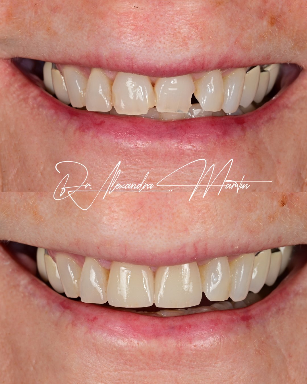 The smallest changes can completely change the way a smile feels.⁠
⁠
In the before, you can see uneven edges, worn enamel, and spacing that interrupted the flow from one tooth to the next. The proportions were off, and the light was catching in all t