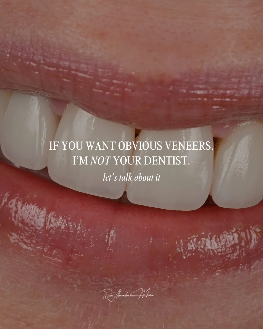 There is a reason I talk about restraint more than I talk about &ldquo;wow.&rdquo;⁠
⁠
Because anyone can make teeth look different. Very few can make them look untouched.⁠
⁠
Every case you see here requires saying no to something.⁠
⁠
Refinement is no
