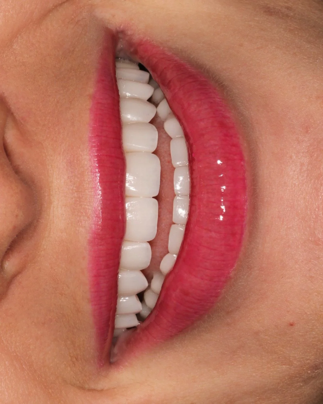 Time alters vertical dimension.⁠
⁠
As enamel wears, facial support decreases. Rebuilding height restores lower third definition and improves functional stability.⁠
⁠
In this case, upper and lower arches were reconstructed with a combination of crowns