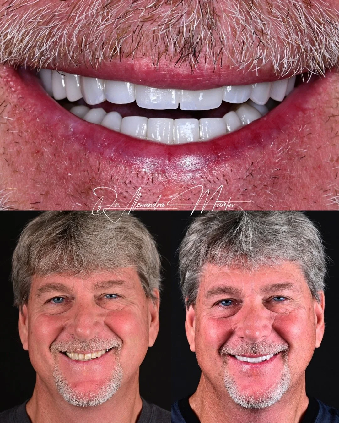 This patient came to us with existing crowns that were no longer supporting the bite or the overall balance of the smile. What began as a conversation about replacing older restorations quickly became an opportunity to rebuild the structure of the en