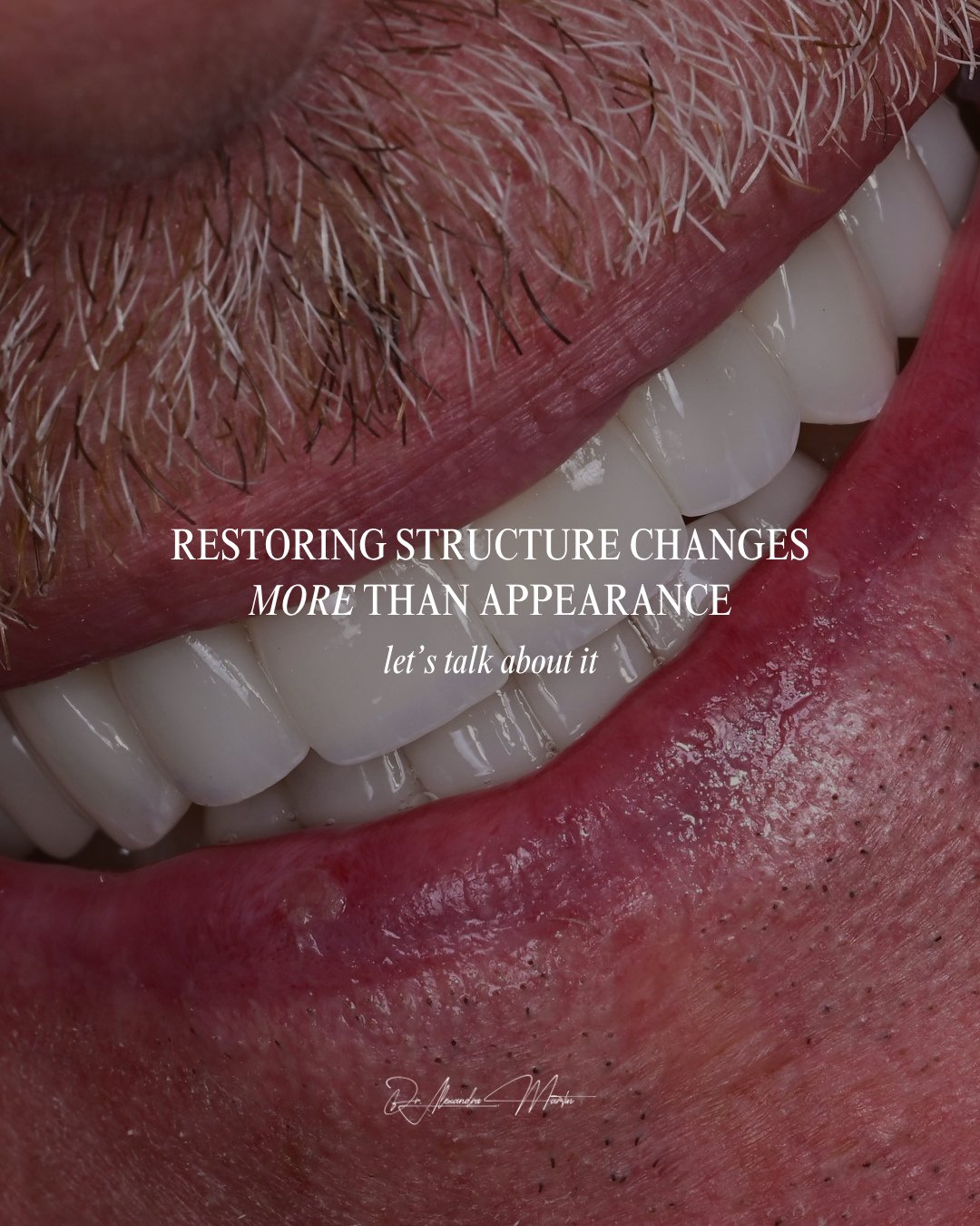 Many conversations around cosmetic dentistry begin with color or alignment. In reality, the more important question is how the teeth function together.⁠
⁠
Over time, natural wear or previous restorations can reduce tooth height and alter the way the 