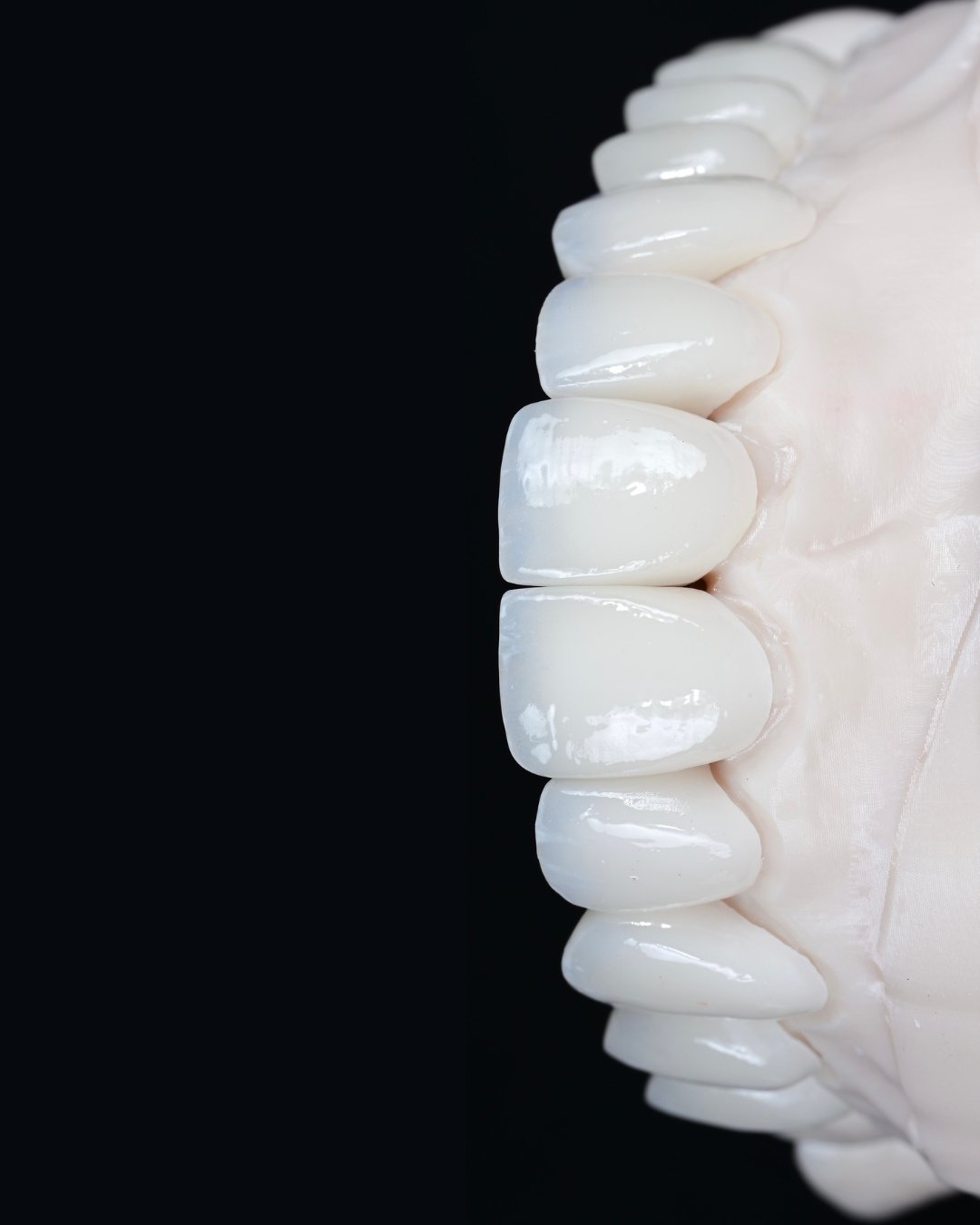 The visible result of a veneer case begins long before the ceramics are created.⁠
⁠
After the bite is evaluated and the structural plan is established, the laboratory work becomes an extension of that design. Edge position, proportion, and how the te