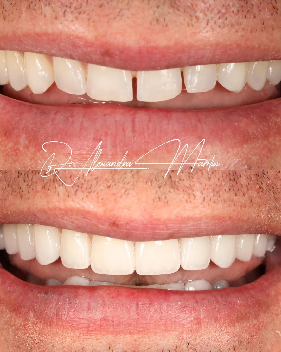 Structure changes everything.⁠
⁠
This transformation was not about simply making the teeth brighter. It began with restoring proportion, rebuilding support, and reestablishing balance within the bite. When that foundation is addressed first, the smil