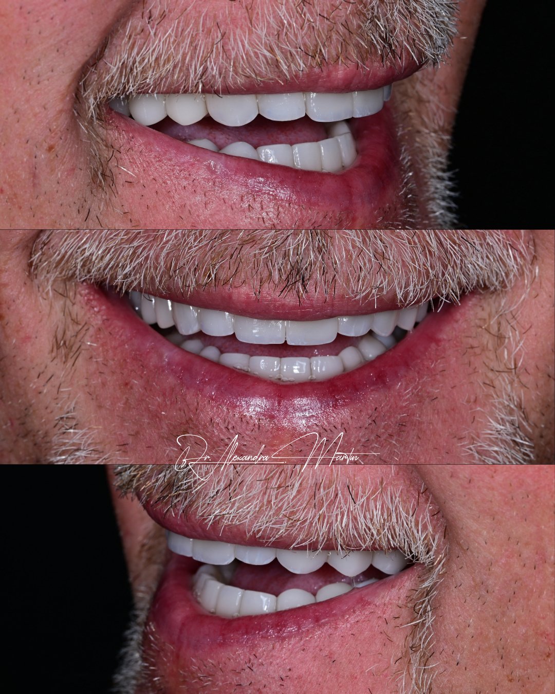 A smile is never viewed from just one angle.⁠
⁠
The left, the right, and the frontal view each reveal something different about proportion, contour, and how the teeth interact with light. Designing veneers requires consistency across all of those per