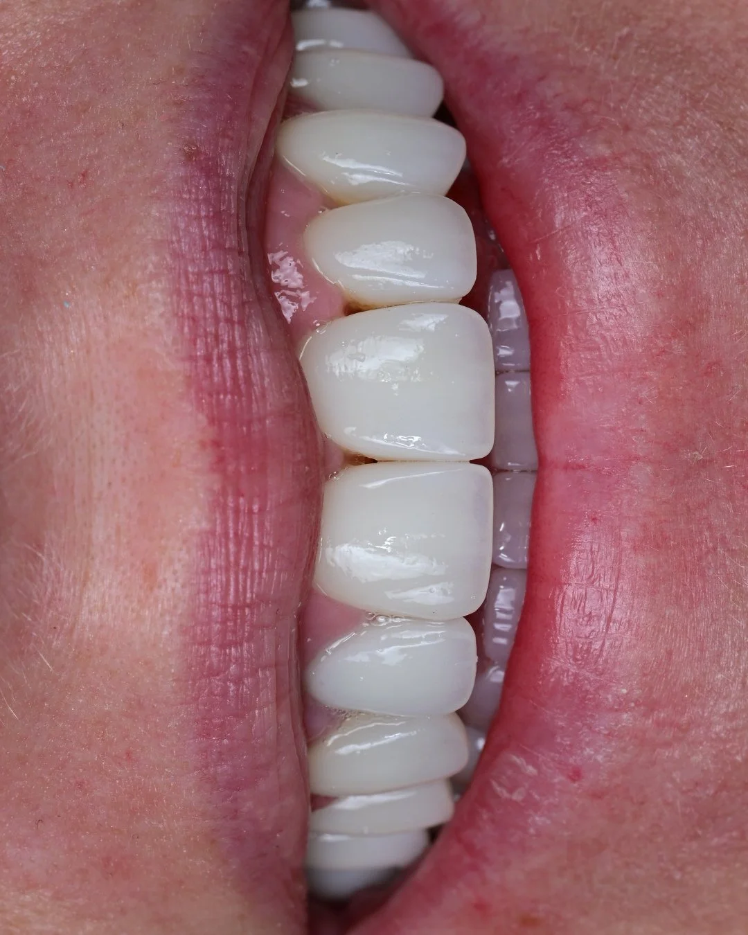 A smile transformation should look more natural with time, not less.⁠
⁠
As the gums settle and the tissue continues to mature, the proportions of the teeth and the surrounding architecture begin to integrate more fully. In this patient's case, restor
