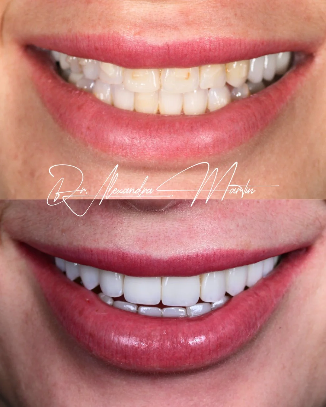 Orthodontics created the foundation for this case.⁠
⁠
After Invisalign aligned the arches, a combination of crowns and veneers restored structure across the upper and lower front teeth. By adding volume to the bite, we were able to reestablish the ve