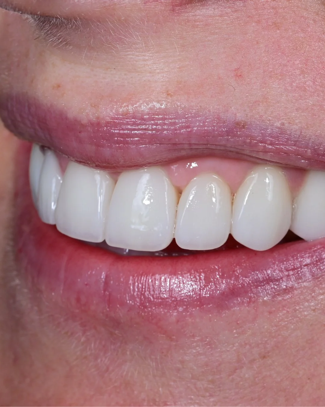 The way a smile interacts with light is often overlooked.⁠
⁠
Translucency, surface texture, and subtle variation allow the teeth to reflect light in a way that feels natural. Without those details, the result can appear flat, even if the shape is cor