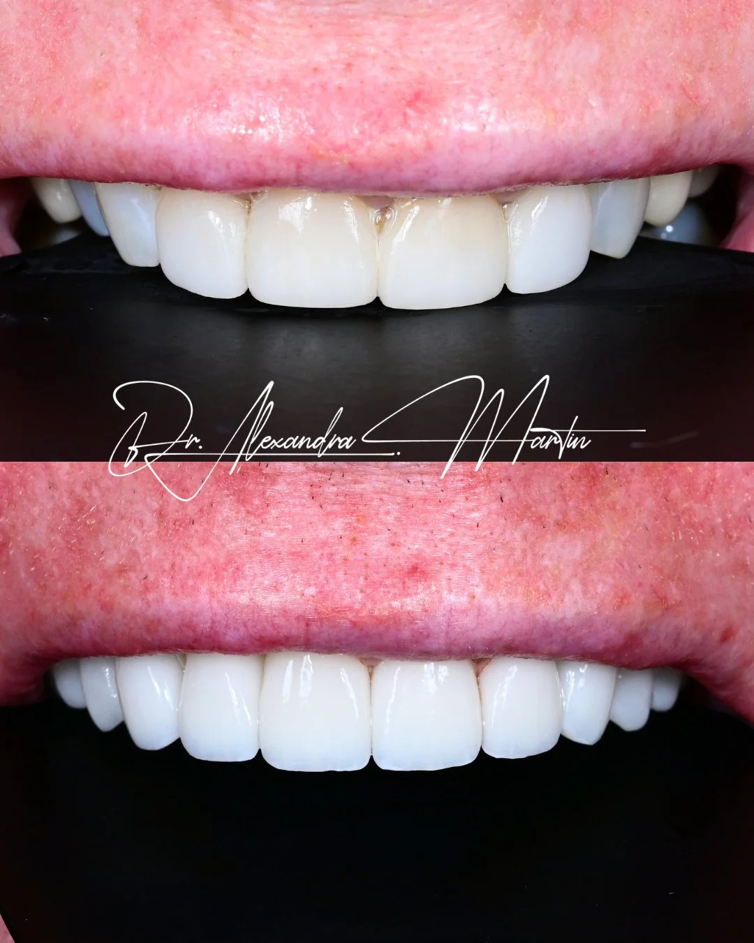 What appears subtle here is the result of intentional change.⁠
⁠
This case included ten upper veneers and crowns, with crowns placed where existing restorations were already present. Using a minimal preparation approach where possible, we refined asy