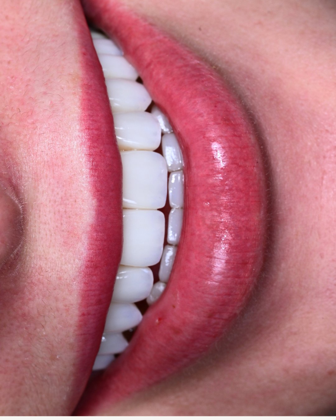 A smile does not exist in isolation.⁠
⁠
It is influenced by how the teeth relate to each other, how they support the lips, and how the bite distributes force. When those relationships are considered together, the result begins to feel integrated with