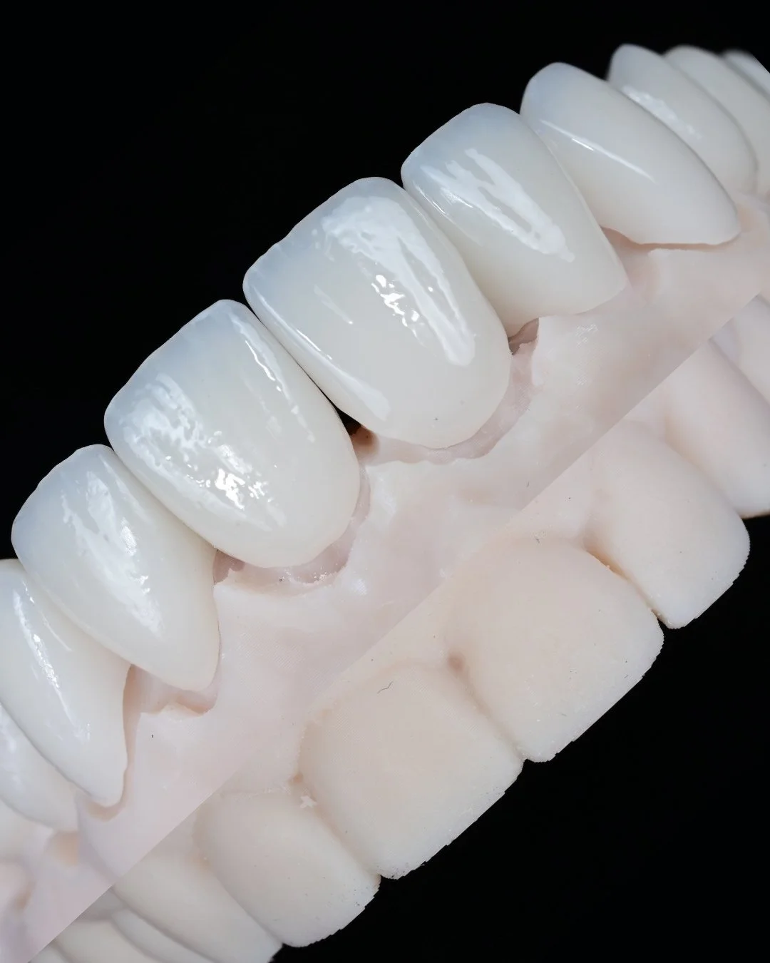Before and after reflects more than the visible surface.⁠
⁠
At this stage, the restorations are fabricated on a working model to control emergence profile, incisal edge position, and surface morphology with precision. Material thickness and layering 