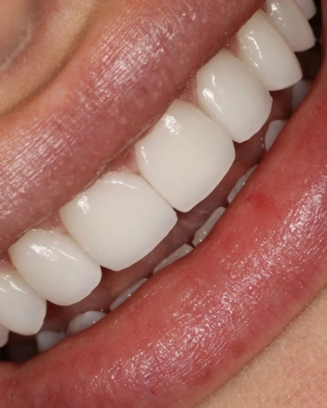 Over time, small changes in the teeth can shift how a smile is perceived.⁠
⁠
Wear, previous dental work, or loss of structure can affect balance. Restoring that balance requires understanding what has changed and rebuilding it in a way that supports 