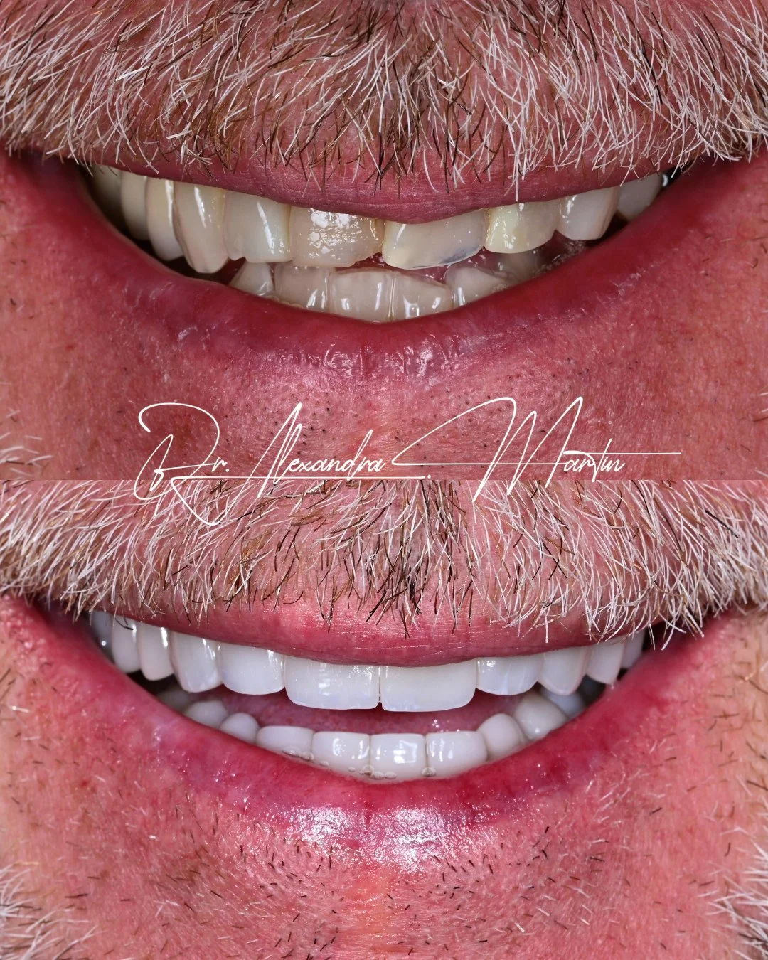 Aesthetic refinement is in the details.⁠
⁠
For this transformation, the focus was on creating a fuller, more balanced smile while preserving a natural sense of proportion. The edges were softened, the shade was brightened, and the overall shape was d