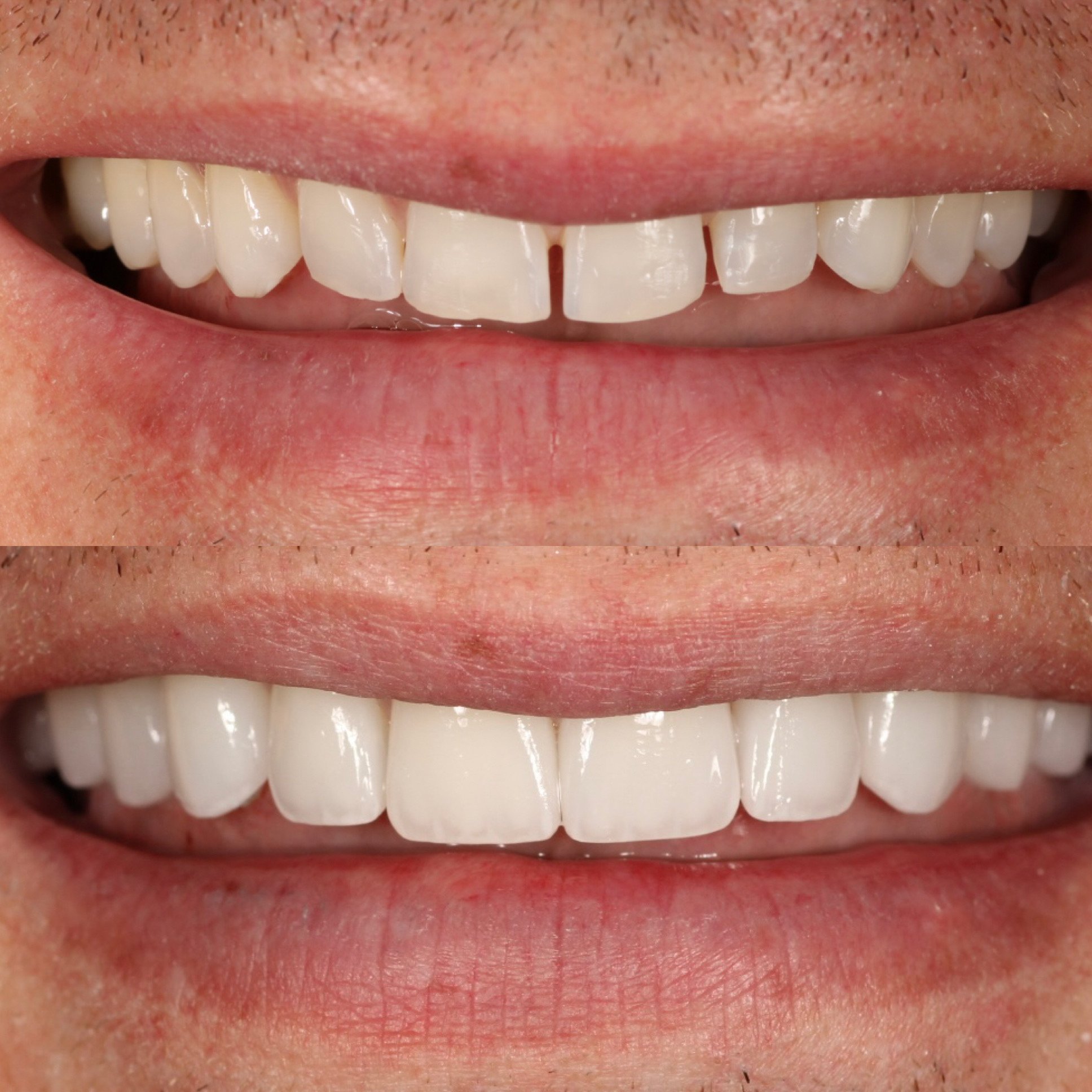 No Prep Veneers Tucson