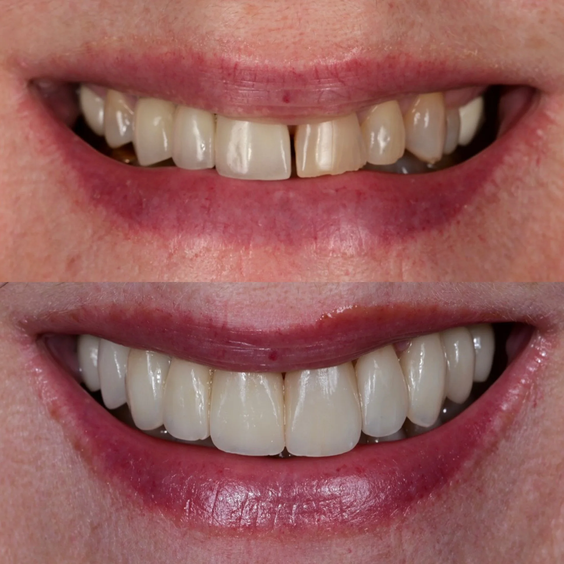 Smile Makeover Tucson