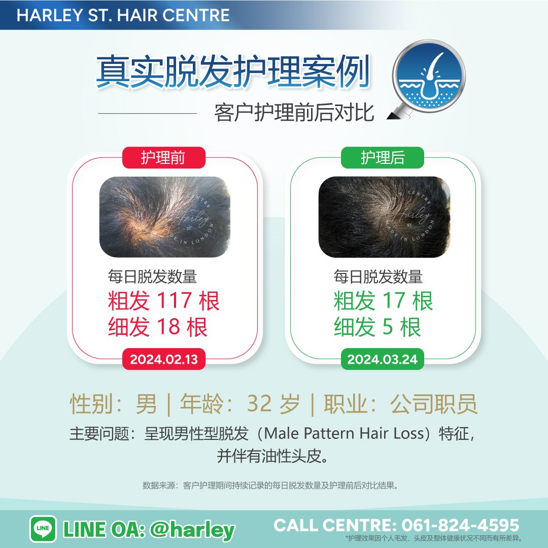 真实客户护理案例：32 岁男性，呈现男性型脱发（Male Pattern Hair Loss）特征，并伴有油性头皮。护理期间持续记录每日脱发数量，护理前每日脱落粗发 117 根、细发 18 根；护理后分别减少至粗发 17 根、细发 5 根，展示 Harley St. Hair Centre 专业毛发与头皮护理前后的变化。