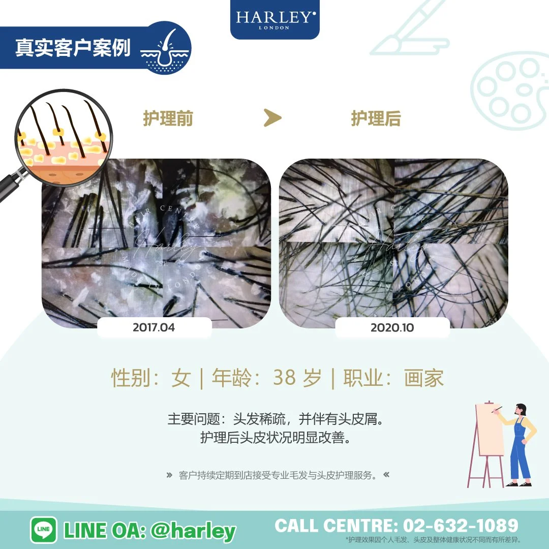 真实客户护理案例：38 岁女性，因头发稀疏及头皮屑问题接受 Harley St. Hair Centre 专业毛发与头皮护理。护理后头皮状况明显改善，头皮环境更加健康，展示护理前后的真实变化。