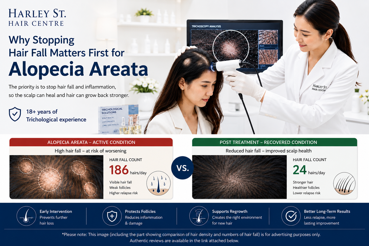 Hair and scalp specialist at Harley St. Hair Centre performing a Trichoscopy Analysis for Alopecia Areata, with a comparison of hair fall count and hair density before and after supportive hair care.