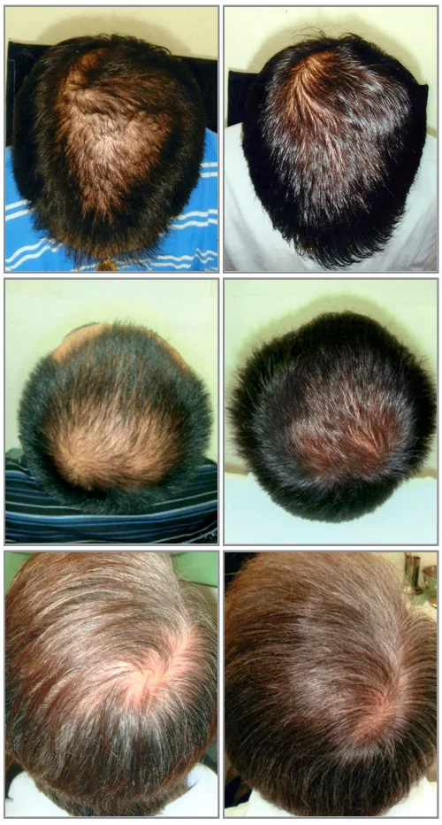 Diagram illustrating the stages of Male Pattern Baldness from early thinning to advanced hair loss.
