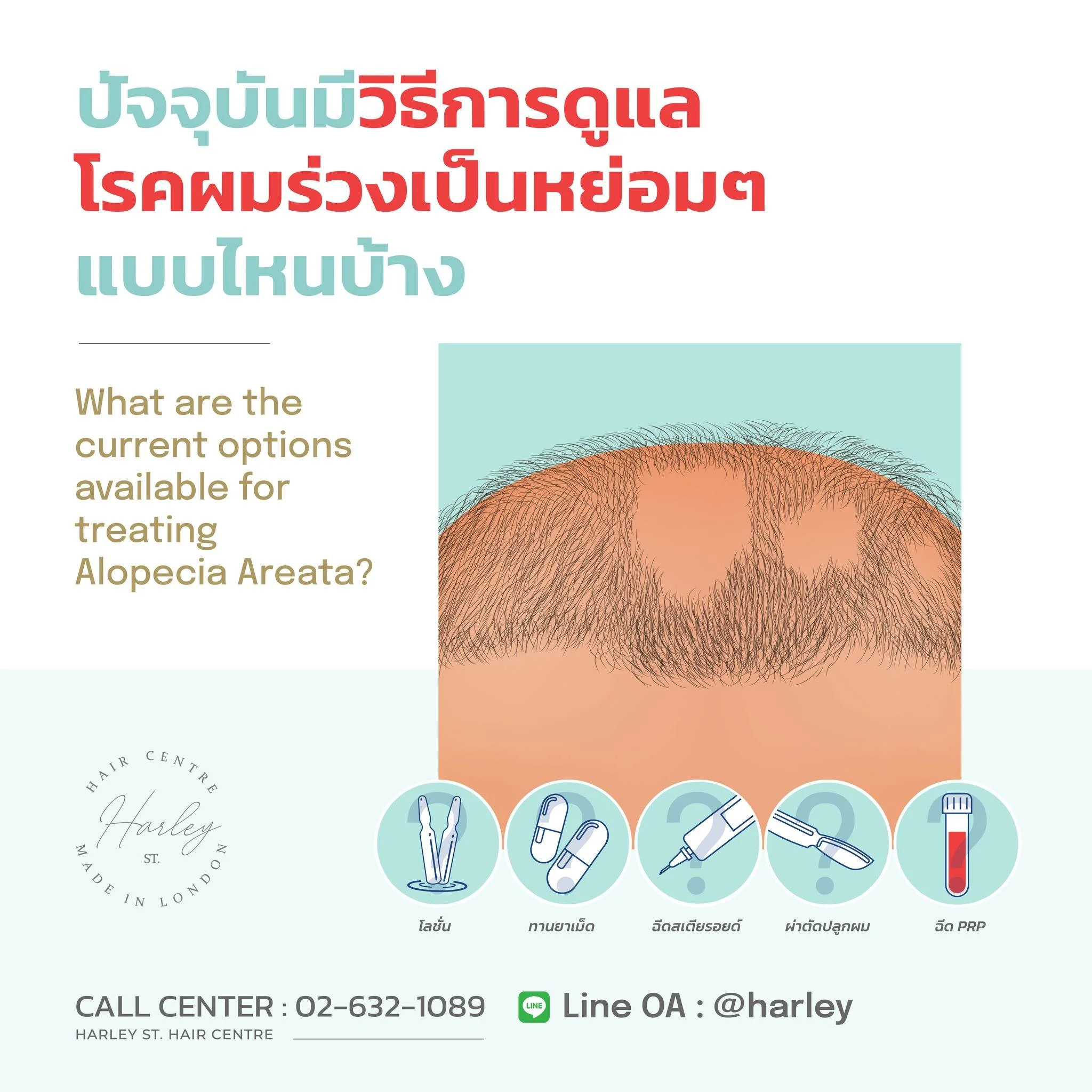 ปัจจุบันมีวิธีการดูแลโรคผมร่วงเป็นหย่อมๆ (Alopecia Areata) แบบไหนบ้าง❓

ปัจจุบันทางการแพทย์มักเลือกรักษาด้วยวิธีการดังต่อไปนี้
💥ให้ครีมรักษาผิวหนังมาทาบริเวณศีรษะ 
💥ให้ครีมที่ส่วนผสมของสเตียรอยด์มาทาบนศีรษะ
💥ฉีดสเตียรอยด์บนศีรษะ
💥ให้ยาเร่งผมขึ้นม