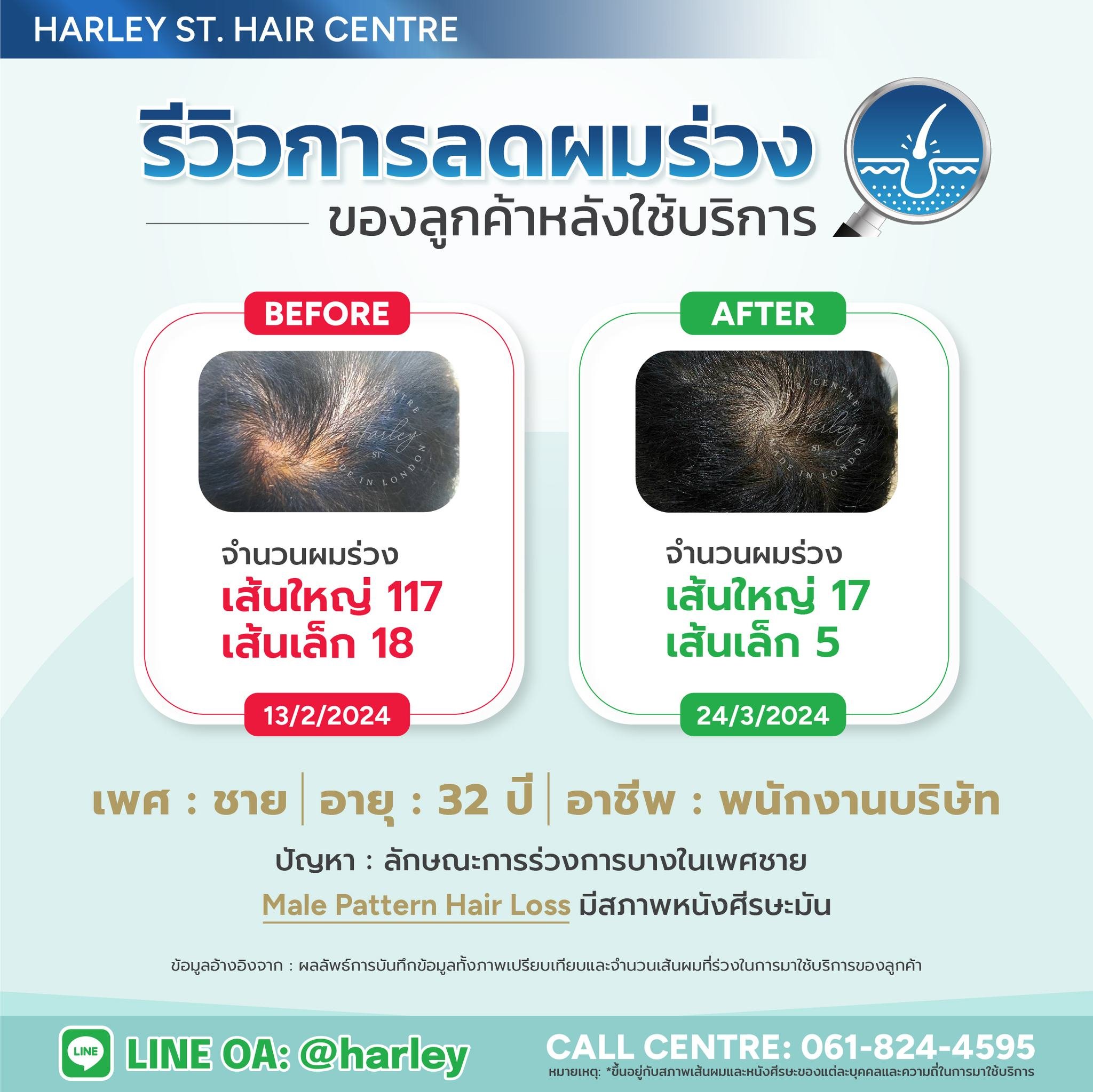 รีวิวการดูแล #ลดผมร่วง จากปัจจัย #ผมร่วงผมบาง ในเพศชาย (Male Pattern Hair Loss)และหนังศีรษะมันของลูกค้า #พนักงานบริษัท ที่มีอายุ 32 ปี💥❗️และได้มาดูแลลดผมร่วงและกระตุ้นเส้นผมที่ Harley St. Hair Centre ศูนย์รวมการดูแลปุญหาเส้นผมและหนังศีรษะอย่างล้ำลึก