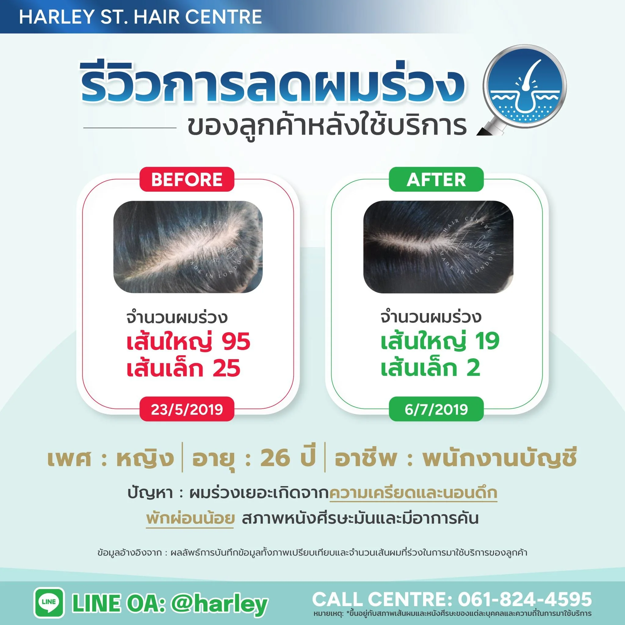 รีวิวการดูแล #ลดผมร่วง จากปัจจัยจากความเครียด การนอนดึกพักผ่อนน้อยและมีสภาพหนังศีรษะมันและคันของลูกค้า #พนักงานบัญชี ที่มีอายุ 26 ปี💥❗️และได้มาดูแลลดผมร่วงและกระตุ้นเส้นผมที่ Harley St. Hair Centre ศูนย์รวมการดูแลปุญหาเส้นผมและหนังศีรษะอย่างล้ำลึกจา