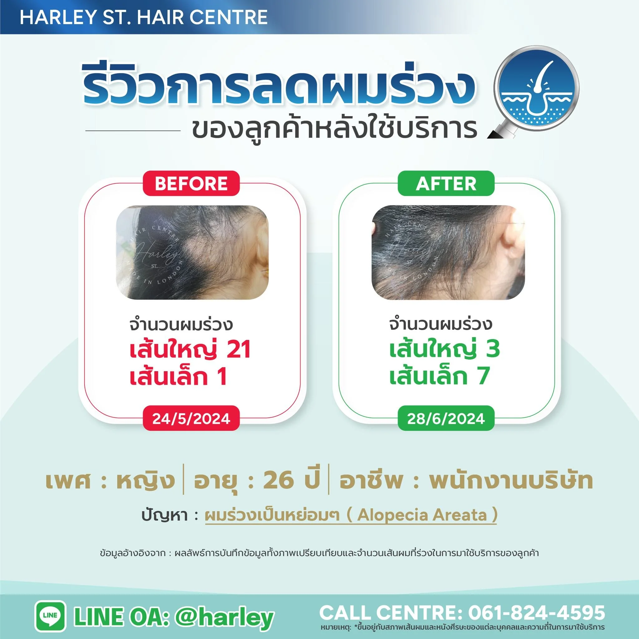 รีวิวการดูแลโรคผมร่วงป็นหย่อมๆ (Alopecia Areata) ของลูกค้า (พนักงานบริษัท) อายุ 26 ปี💥❗️และได้มาดูแลลดผมร่วงและกระตุ้นเส้นผมที่ Harley St. Hair Centre และเห็นผลลัพธ์ที่ดีขึ้นเรื่อยๆ ✅

🇬🇧Customer Review:This female customer suffers from Alopecia A