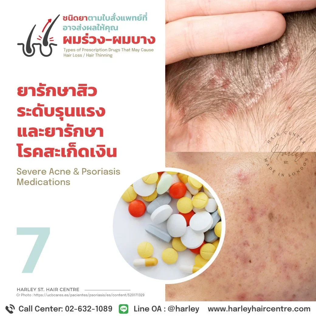 ยารักษาสิวและสะเก็ดเงิน: เมื่อการรักษาผิวอาจส่งผลข้างเคียงให้ "ผมร่วง"
