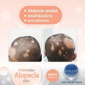 รีวิวภาพก่อนรักษาผมร่วงเป็นหย่อม (Initial Alopecia Areata Case) ที่ Harley St. Hair Centre