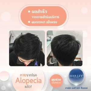 รีวิวผลลัพธ์หลังรักษาผมร่วงเป็นหย่อม (Full Hair Recovery) สำเร็จที่ Harley St. Hair Centre
