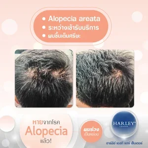 รีวิวผลความคืบหน้าระหว่างการรักษาผมร่วงเป็นหย่อม (Alopecia Areata Progress) ที่ Harley St. Hair Centre