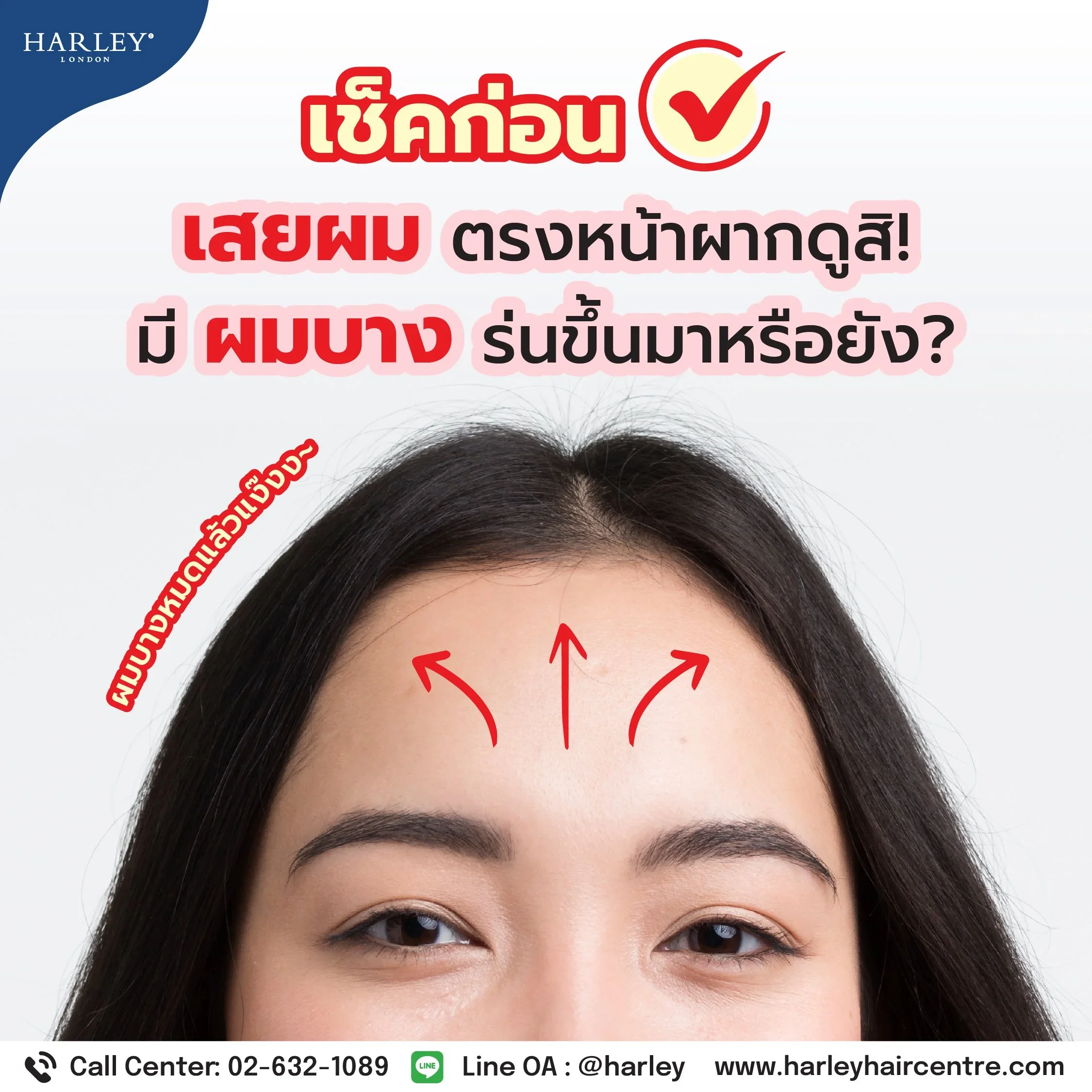 เช็คด่วน! เสยผมหน้าผากดูสิ มีสัญญาณ "ผมบางร่น" (Receding Hairline) หรือยัง?