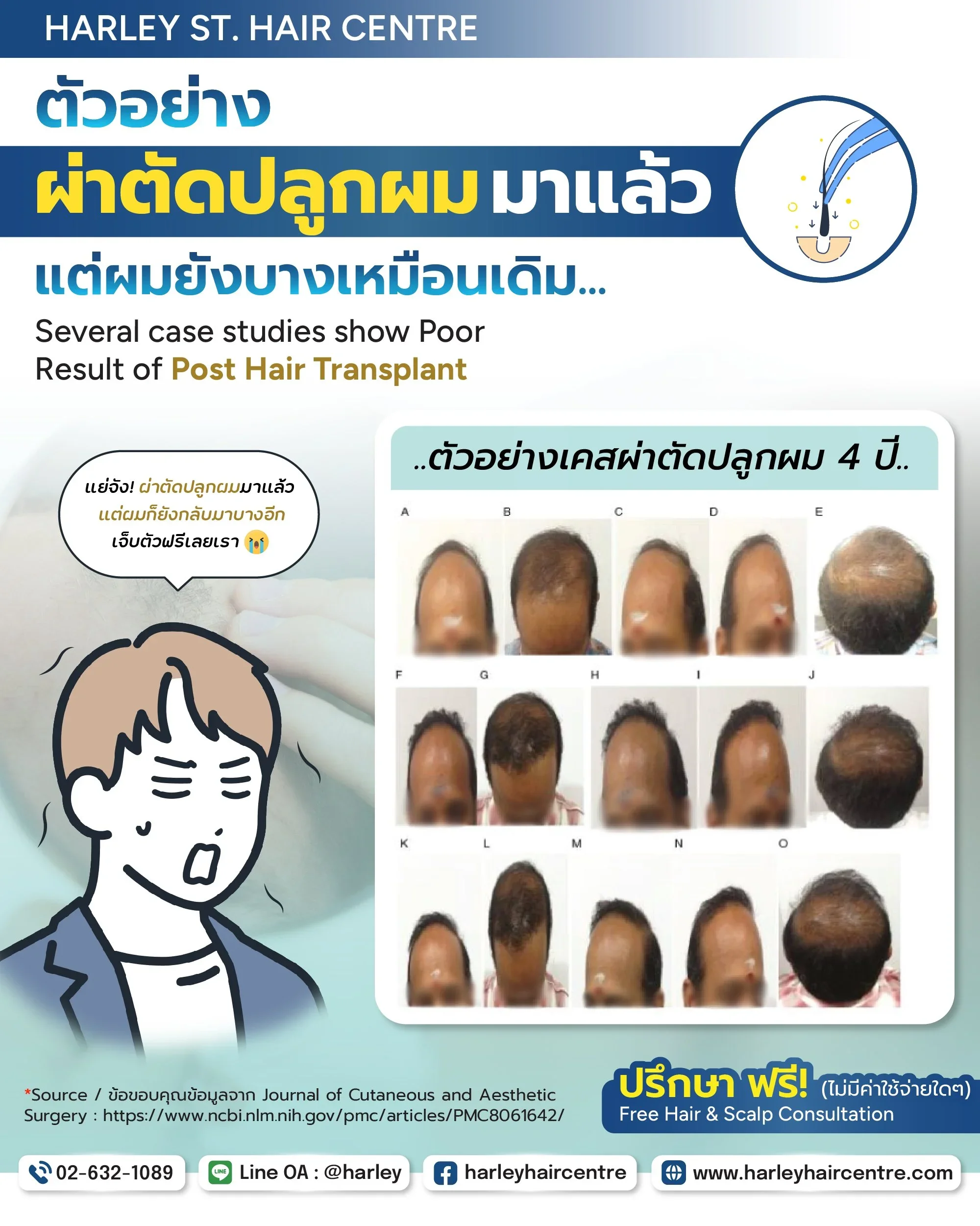 ทำไมผ่าตัดปลูกผมมาแล้ว (Post Hair Transplant) แต่ผมยังบางเหมือนเดิม?