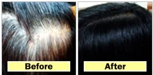 Understanding Female Hair Loss and Thinning.