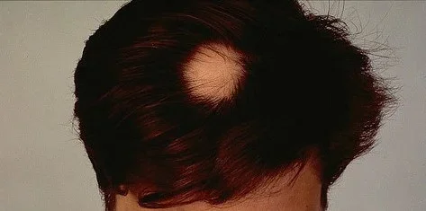 Hormones and Hair Loss: Why DHT is the Main Culprit.