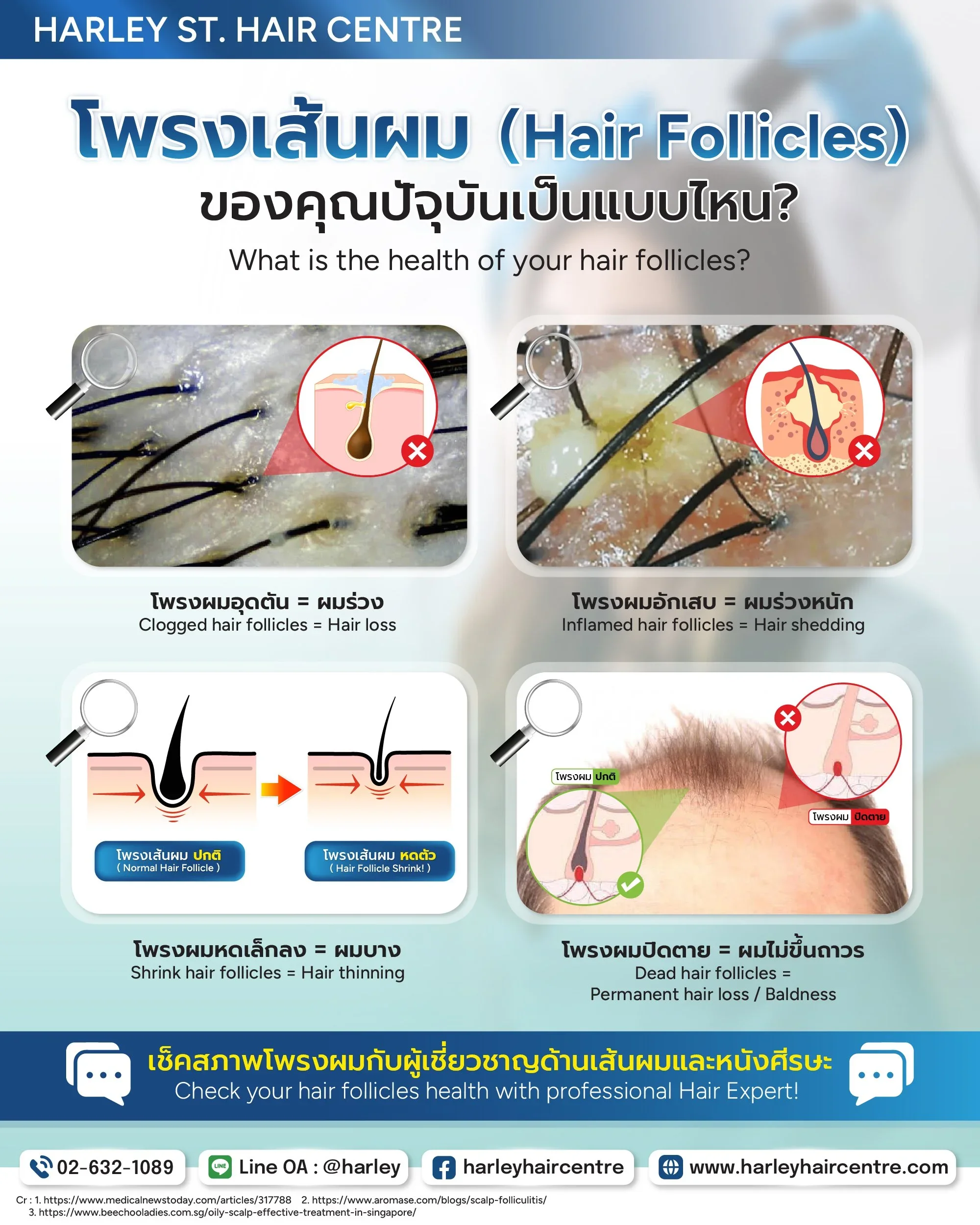 เช็กด่วน! คุณกำลังมีปัญหาผมขึ้นน้อย เพราะโพรงผม (Hair Follicle) มีปัญหาหรือเปล่า?