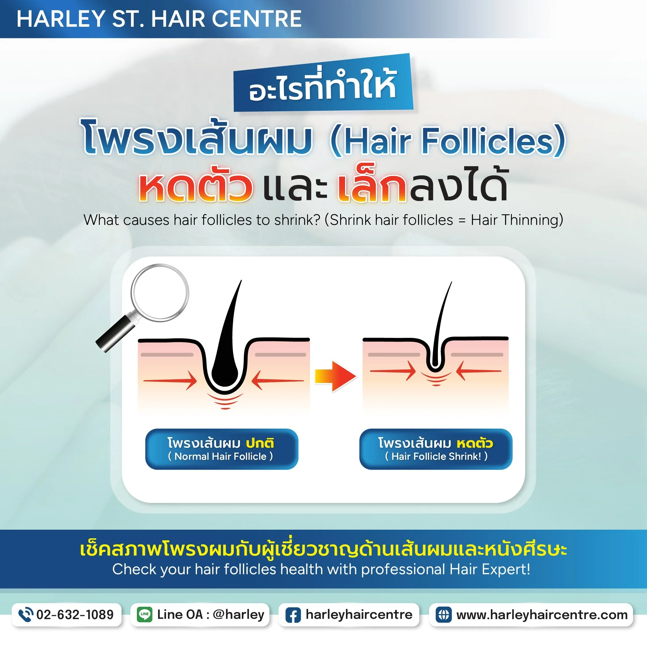 กราฟิกอธิบายโพรงเส้นผมหดตัว เช่น อายุ กรรมพันธุ์ ฮอร์โมน และการขาดแร่ธาตุ