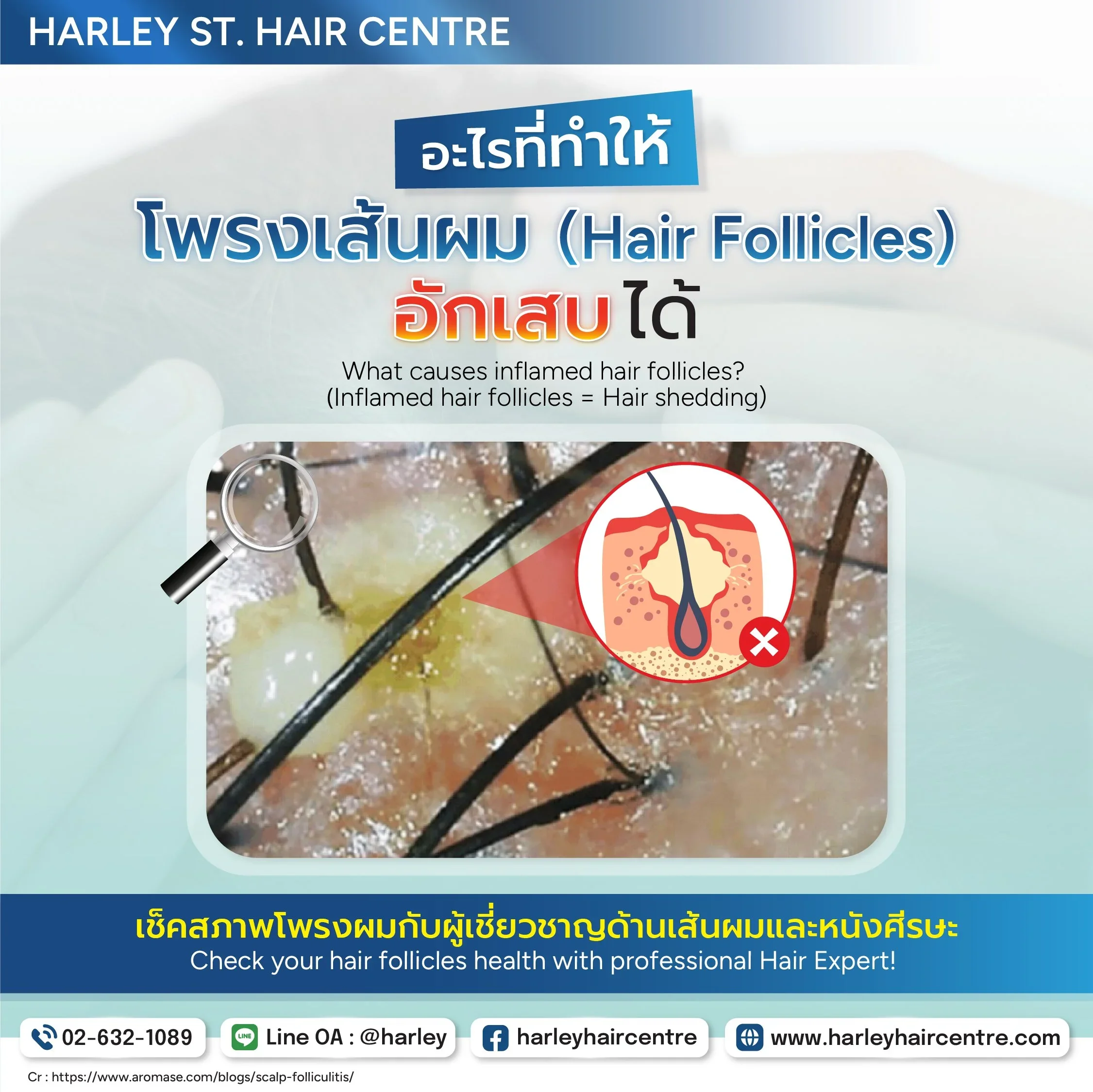 อะไรทำให้โพรงเส้นผมอักเสบได้? (What causes inflamed hair follicles?)