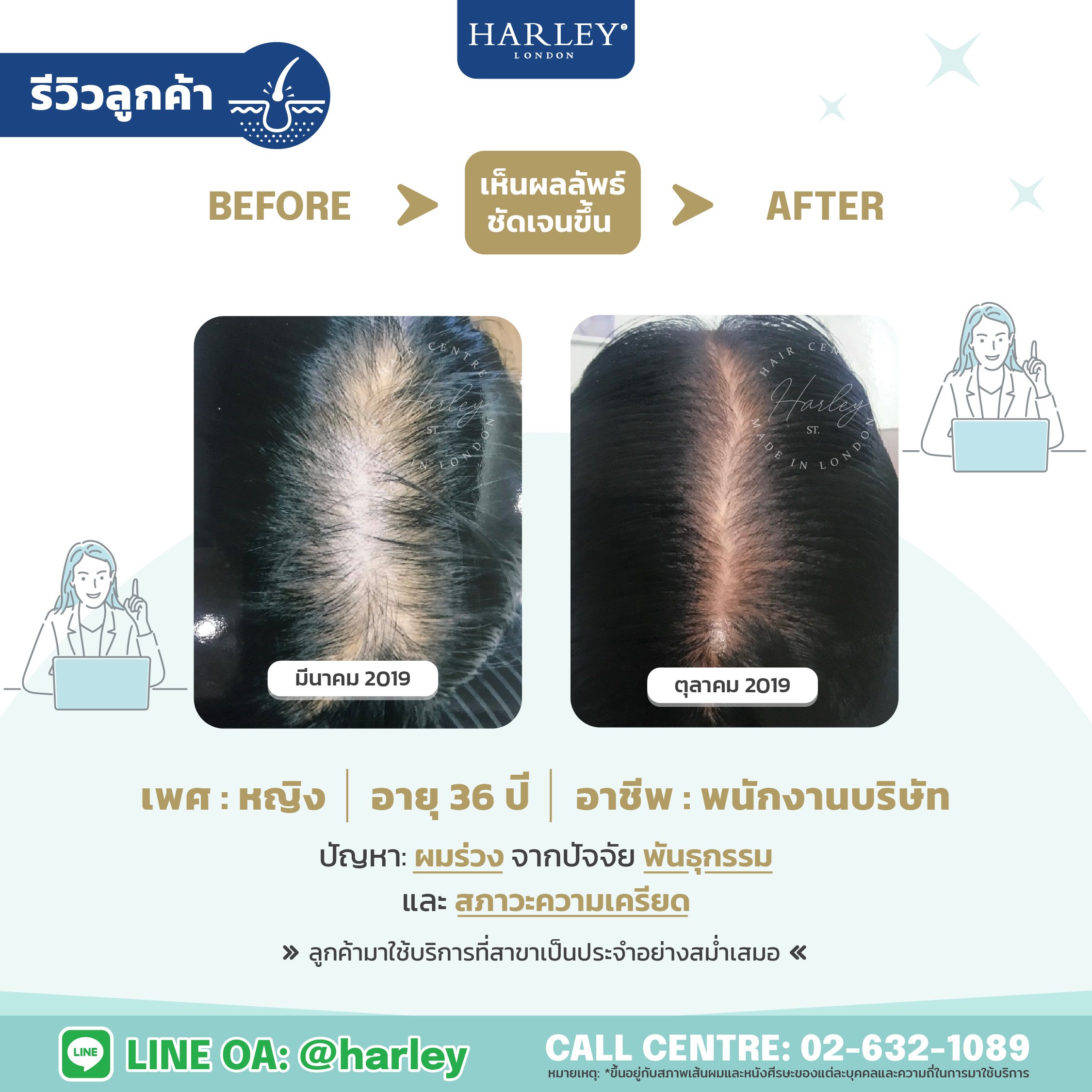 เพศหญิง อายุ 36 ปี ผมบางจากพันธุกรรม 