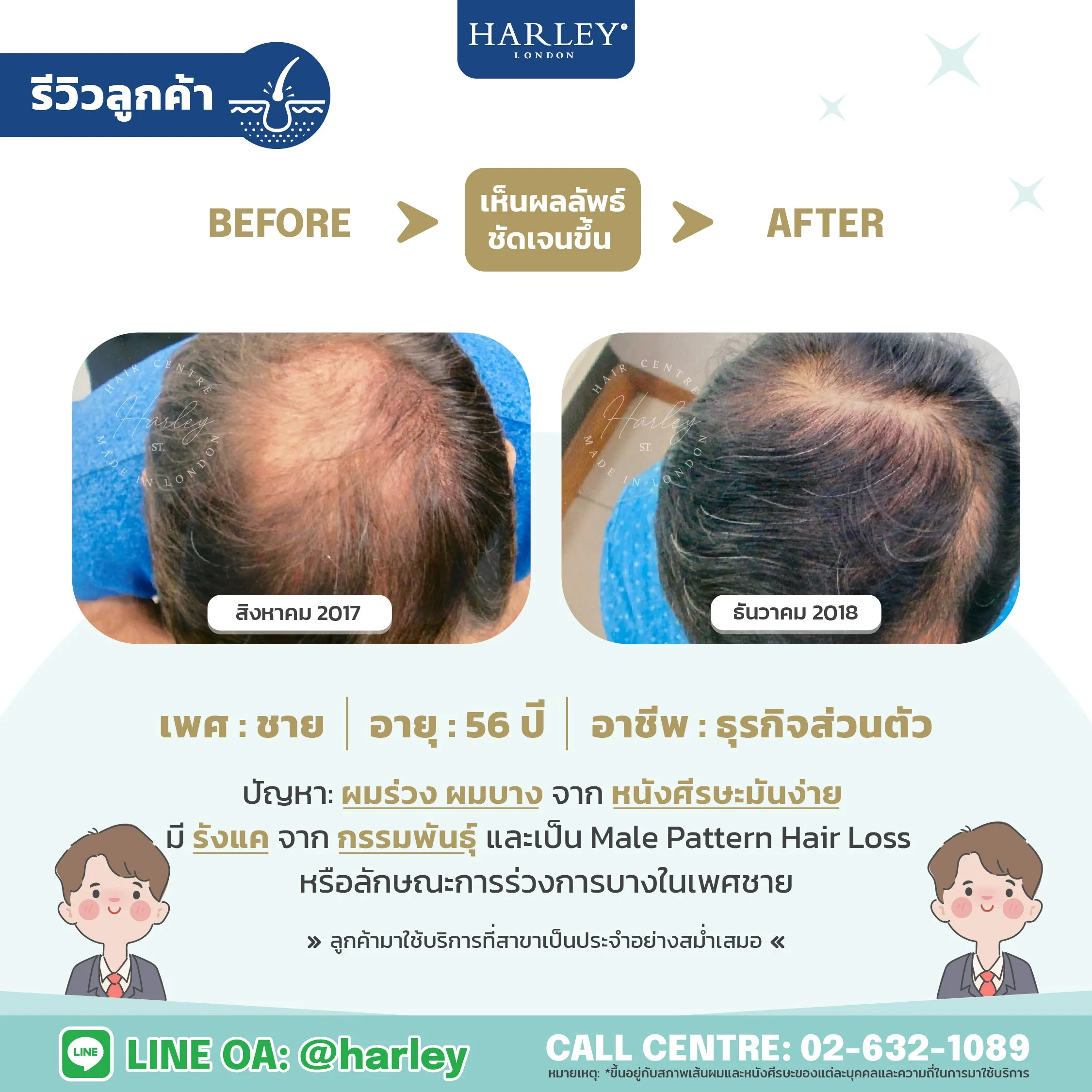 เพศชาย อายุ 56 ปี ผมบางกลางศีรษะ 