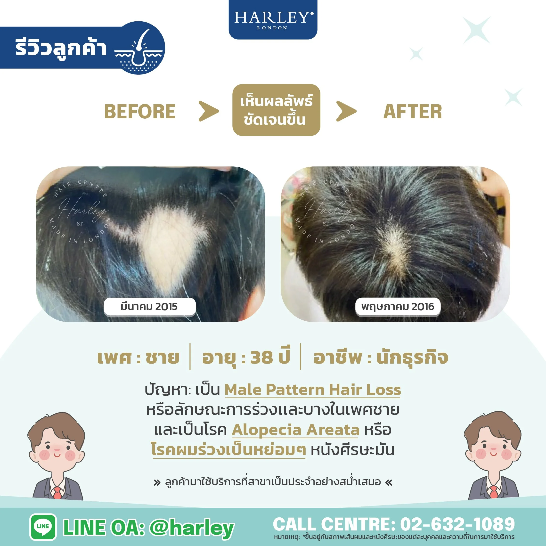 รีวิวลูกค้าชาย อายุ 38 ปี Male Pattern Hair Loss และ Alopecia Areata — Harley St. Hair Centre