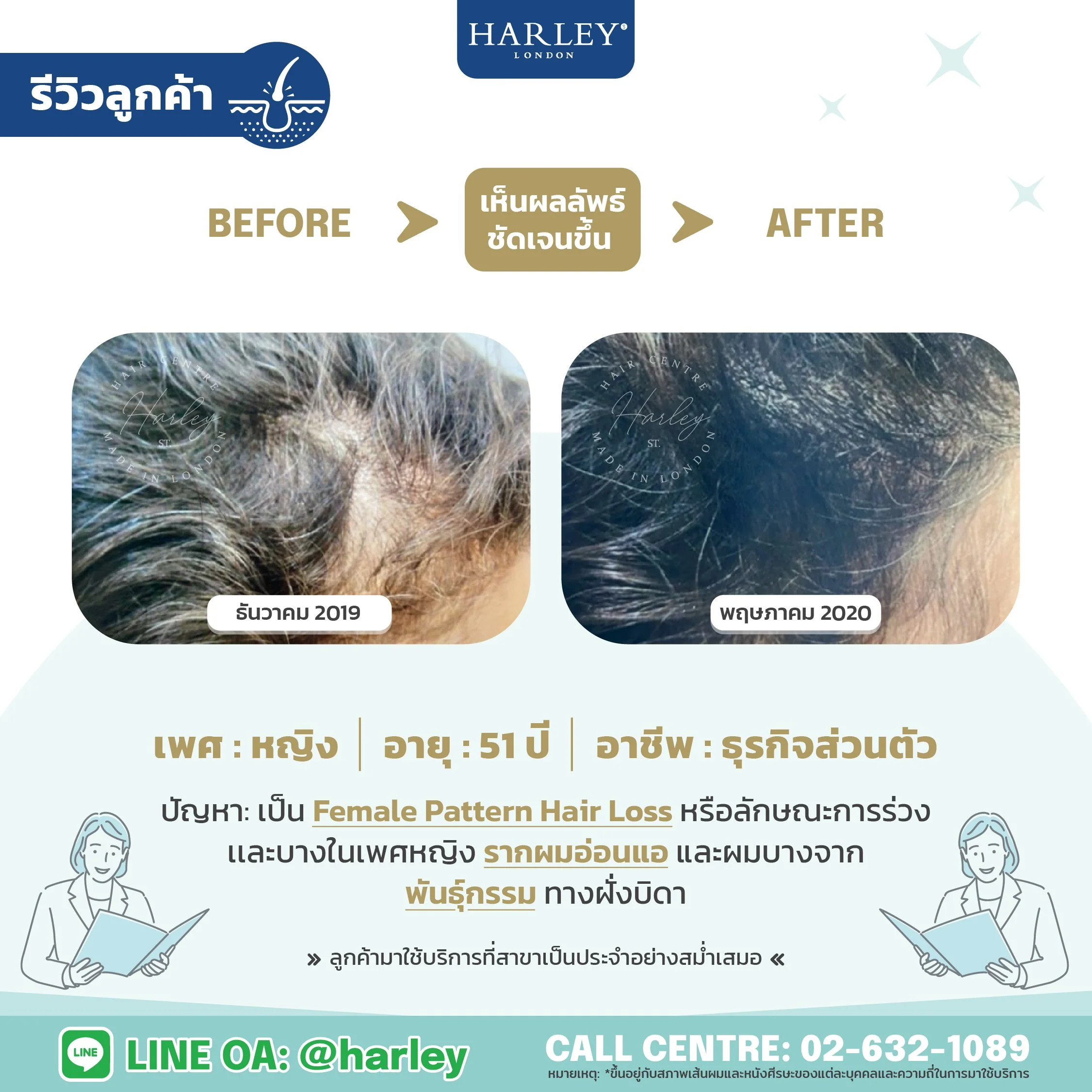 รีวิวลูกค้าหญิง อายุ 51 ปี Female Pattern Hair Loss จากพันธุกรรม — Harley St. Hair Centre