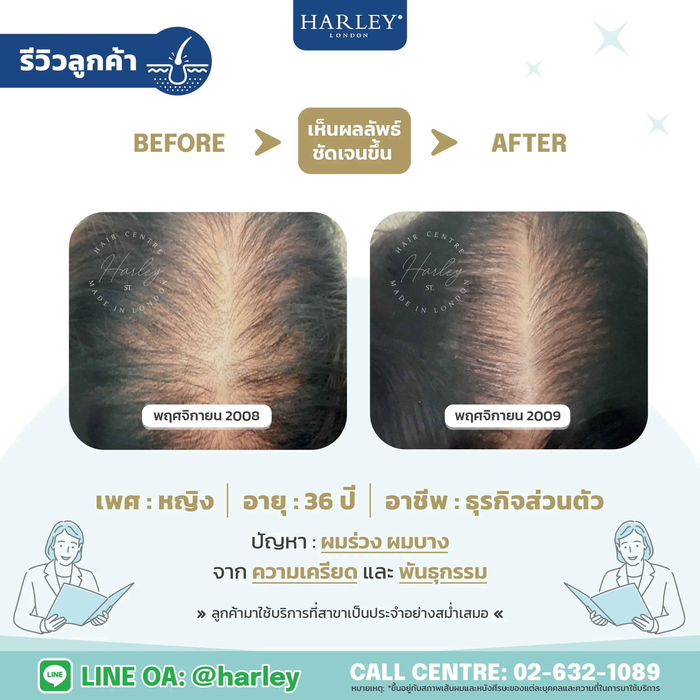 รีวิวลูกค้าหญิง อายุ 36 ปี ผมร่วงผมบางจากความเครียดและพันธุกรรม — Harley St. Hair Centre